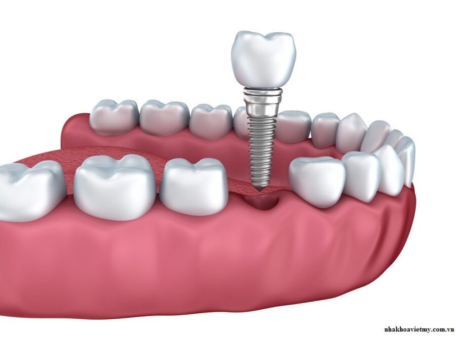 trồng răng implant