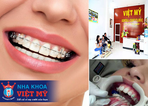 địa chỉ chỉnh nha và niềng răng giá rẻ nhất tại Kiên Giang