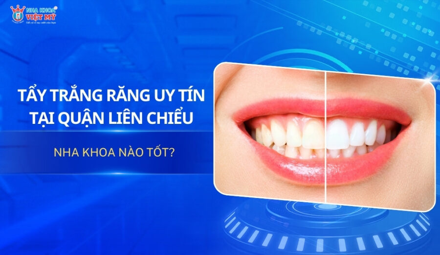 thumbnail tẩy trắng răng uy tín tại quận Liên Chiểu