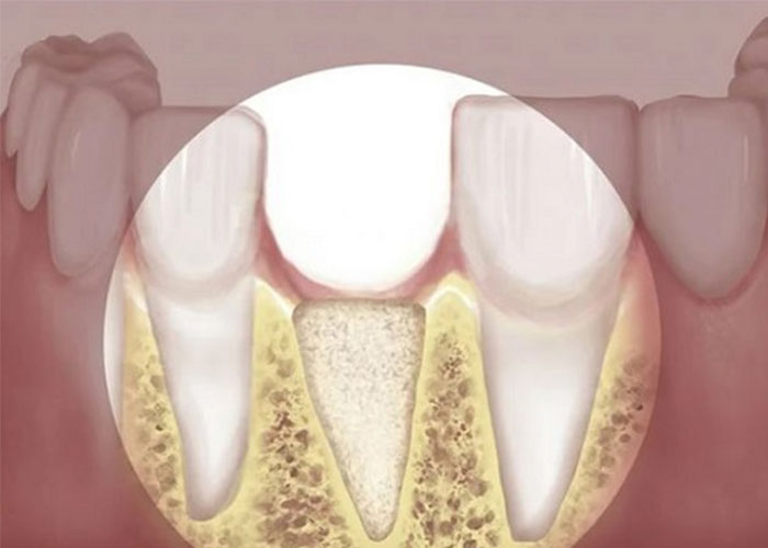 mất răng làm tiêu xương hàm