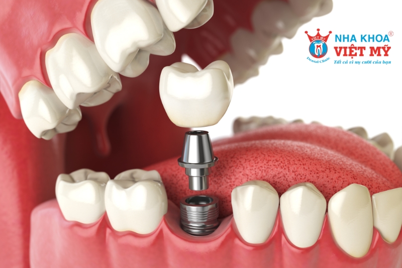 implant giúp khắc phục hậu qu?của việc mất răng