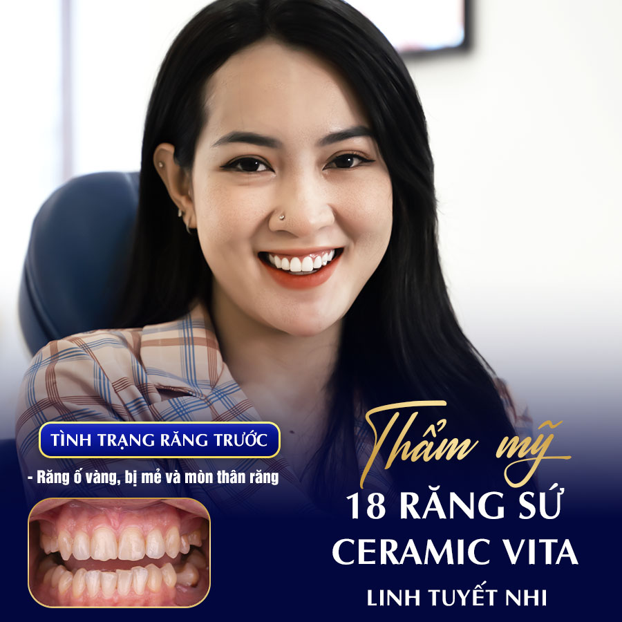 Răng sứ Ceramic Vita