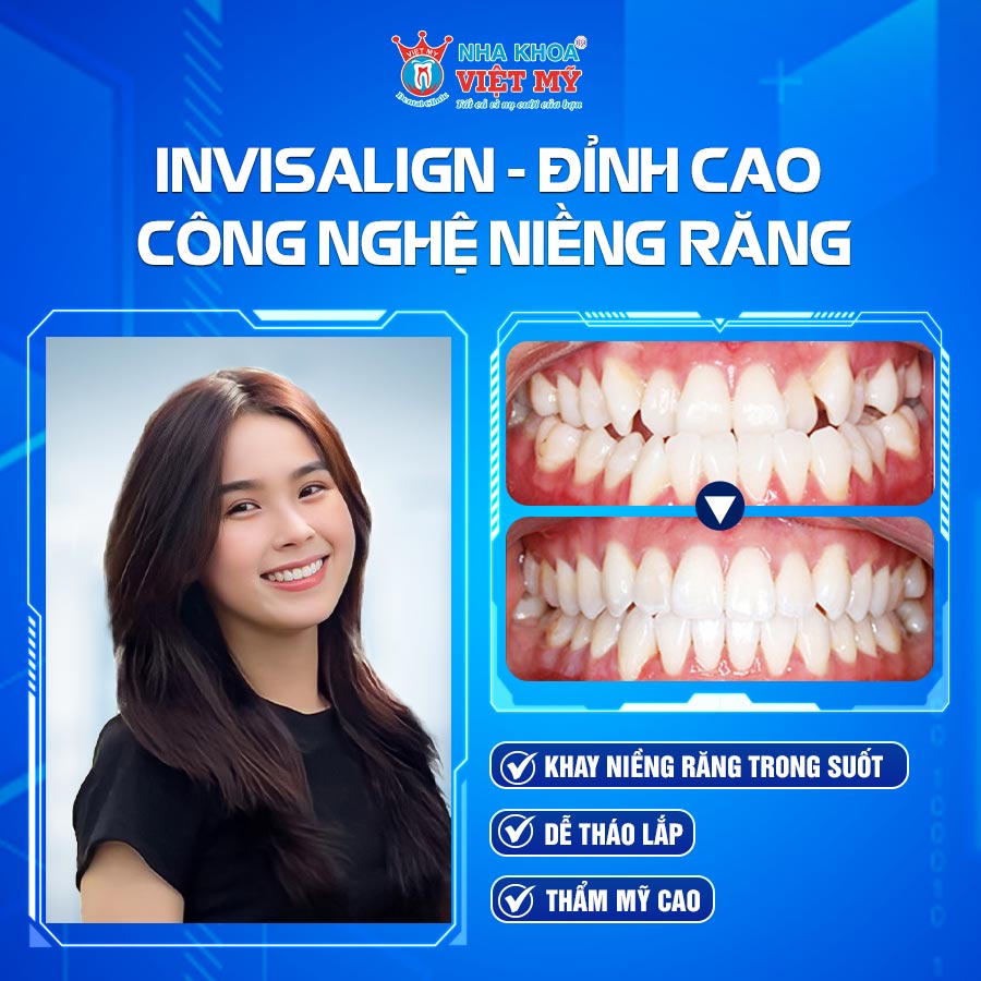 INVISALIGN DINH CAO CONG NGHE