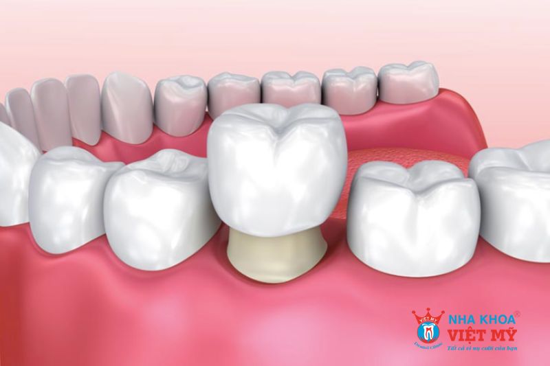 Bọc răng sức có đau không