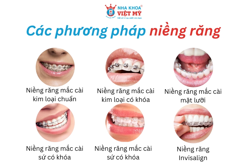 các phương pháp niềng răng