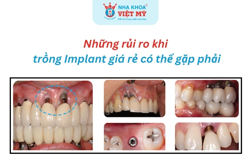 những rủi ro có thể gặp phải khi trồng răng implant