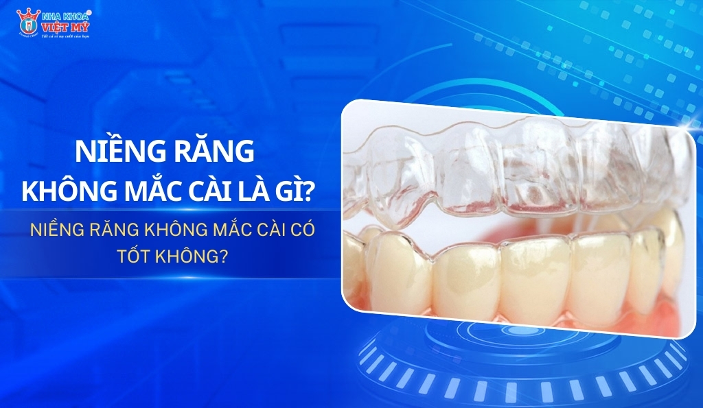 Thumbnail niềng răng không mắc cài là gì? Có tốt không?