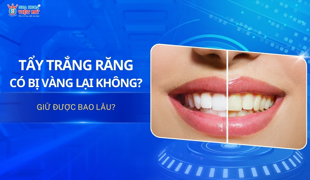 Thumbnail tẩy trắng răng có bị vàng lại không