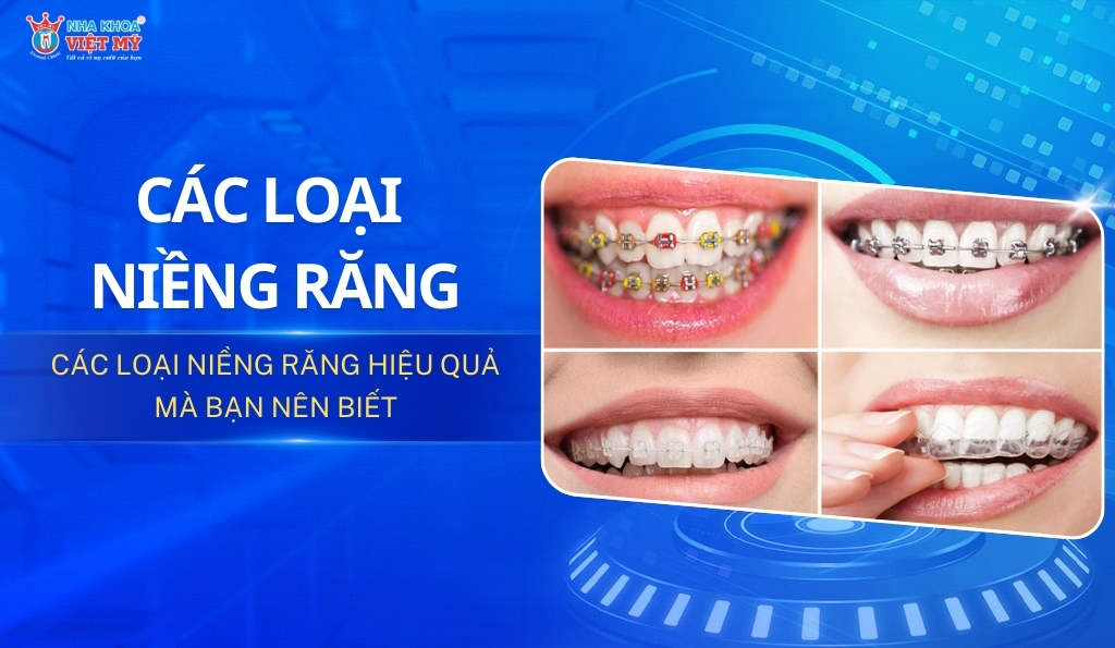 thumbnail các loại niềng răng hiệu quả hiện nay