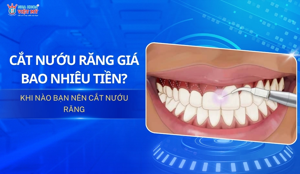 thumbnail cắt nướu răng giá bao nhiêu tiền