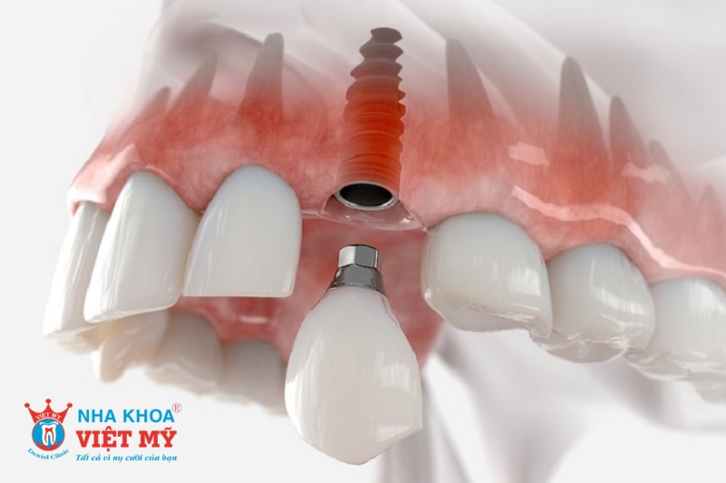 trồng răng implant có đ?bền chắc chắn và lâu dài