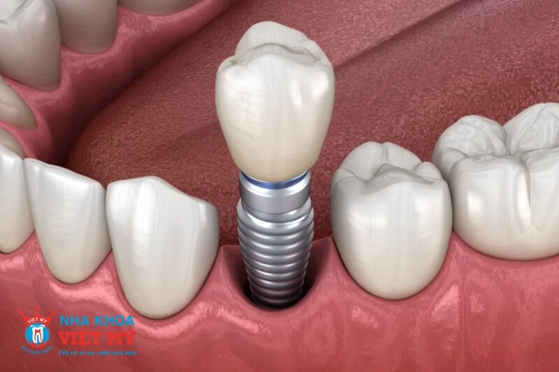 trồng răng implant là gì