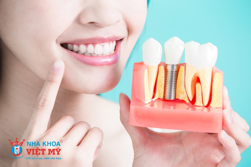 trồng răng implant hiệu quả thẩm mỹ vượt trội