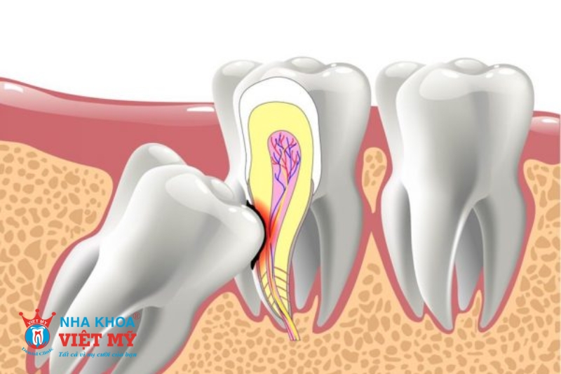 răng khôn mọc lệch ảnh hưởng đến răng số 7