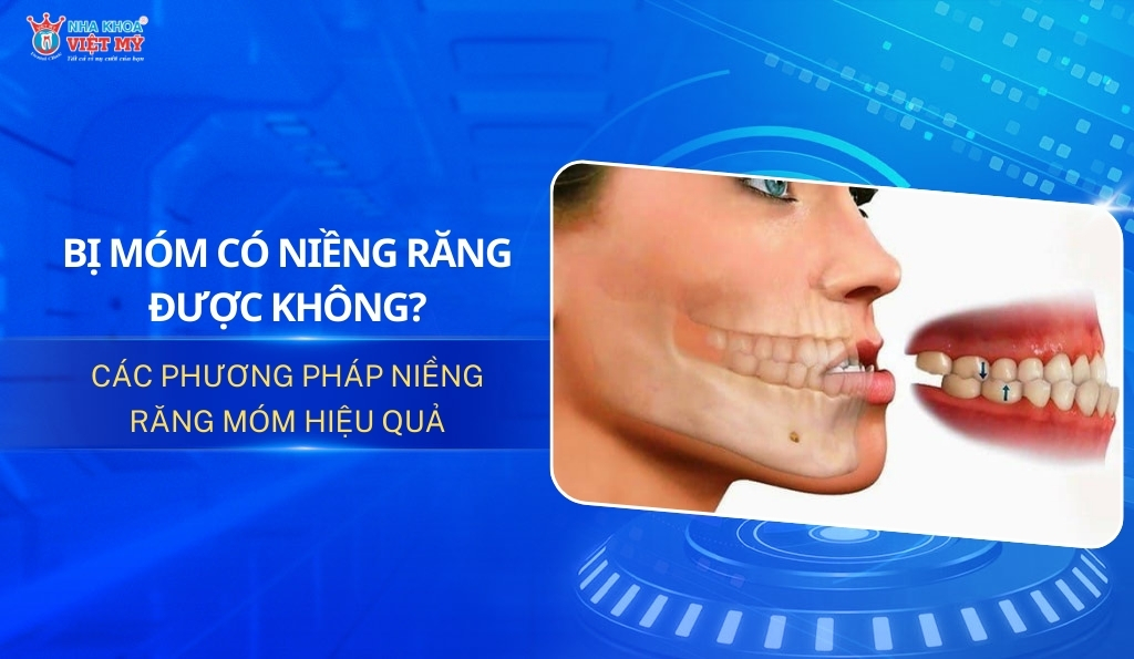 thumbnail bị móm có niềng răng được không