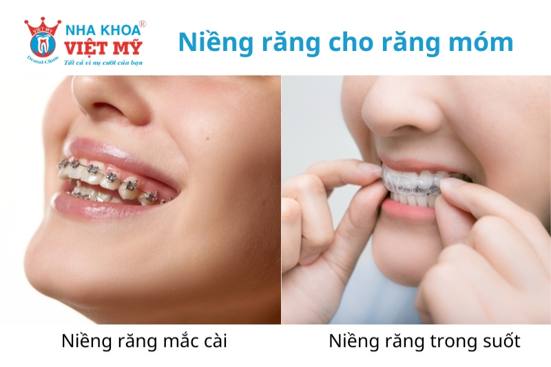 phương pháp niềng răng phổ biến cho răng móm