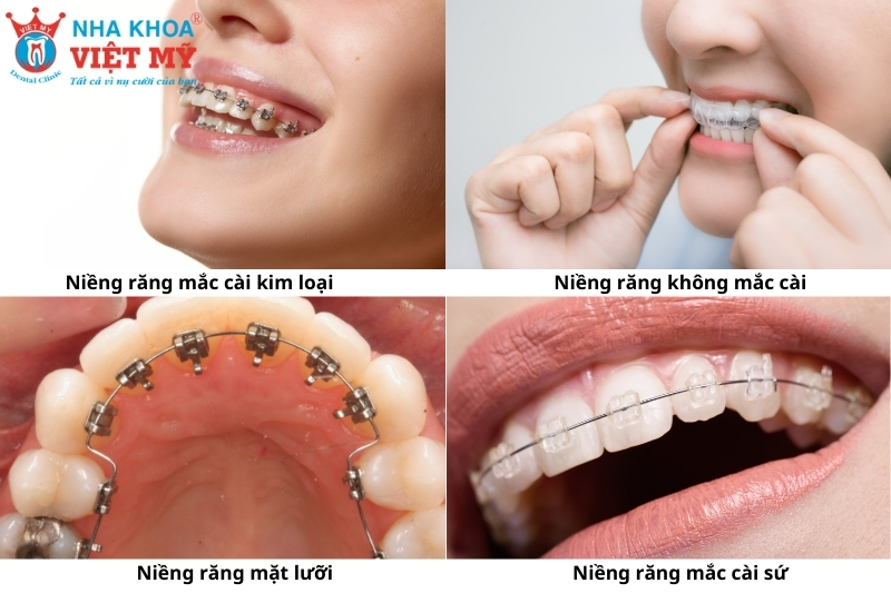 các loại niềng răng phổ biến hiện nay