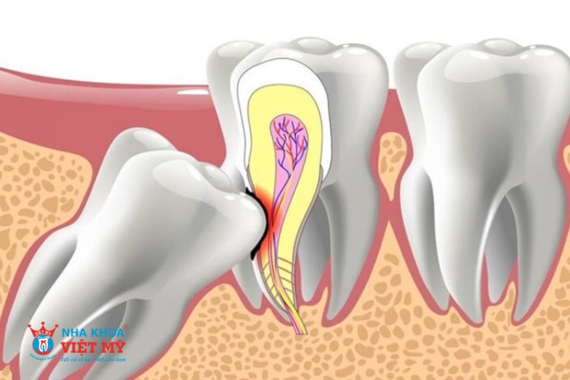 các trường hợp nên nhổ răng khôn hàm dưới