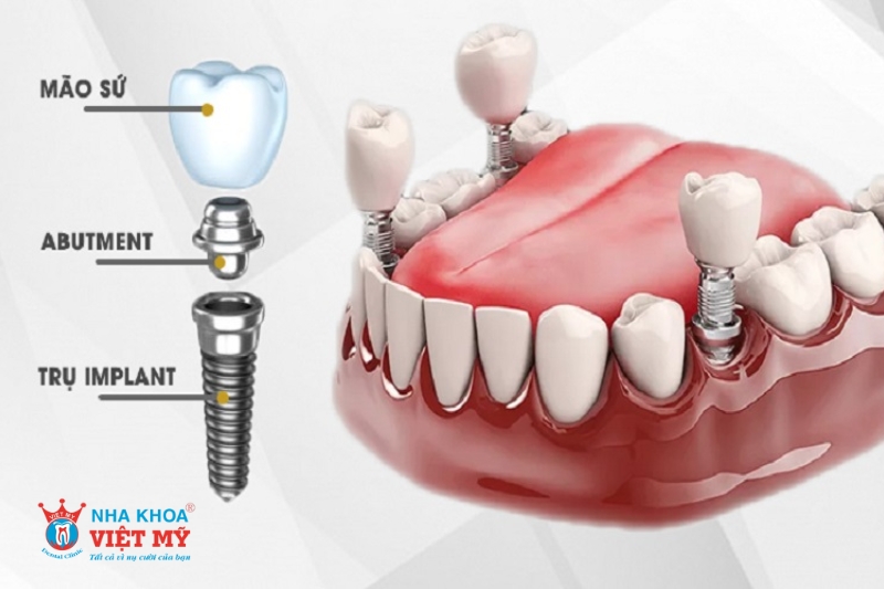 chất lượng tr?implant và răng s? width=