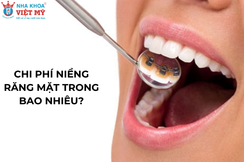 chi phí của niềng răng mặt trong