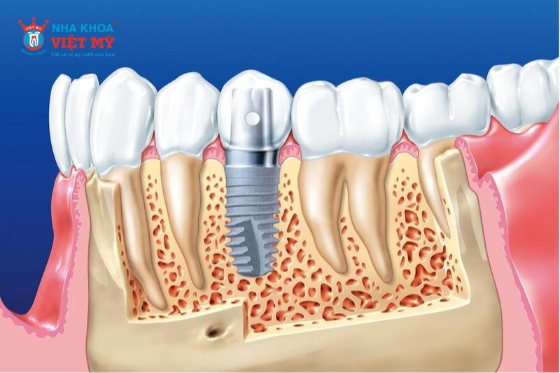 k?thuật trồng răng implant