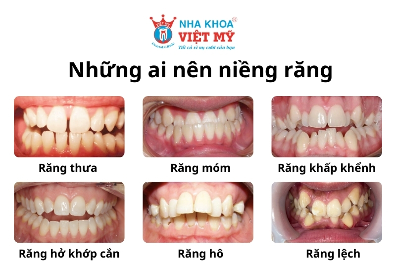 các trường hợp nên đi niềng răng