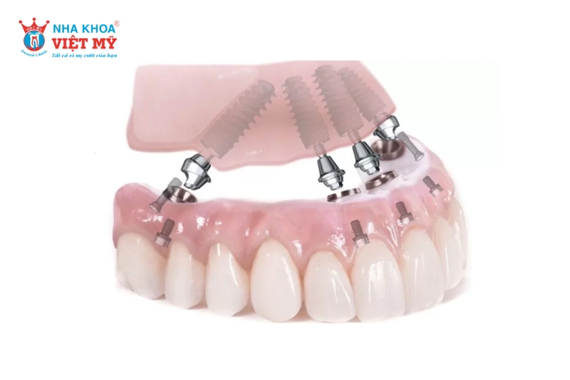 những ưu điểm về trồng răng implant