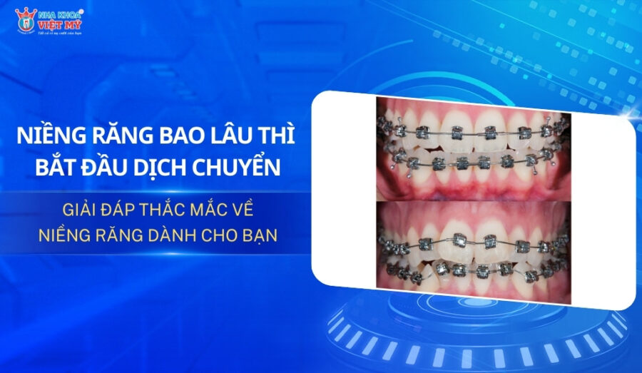 thumbnail niềng răng bao lâu thì bắt đầu dịch chuyển