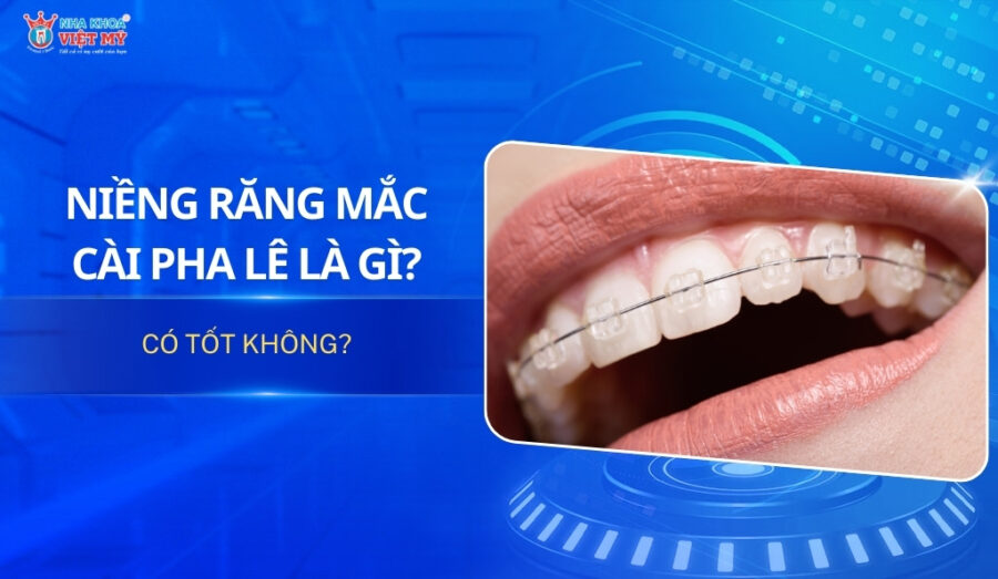 thumbnail niềng răng mắc cài pha lê là gì