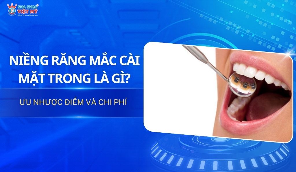 thumbnail niềng răng mặt trong với ưu nhược điểm và chi phí ra sao