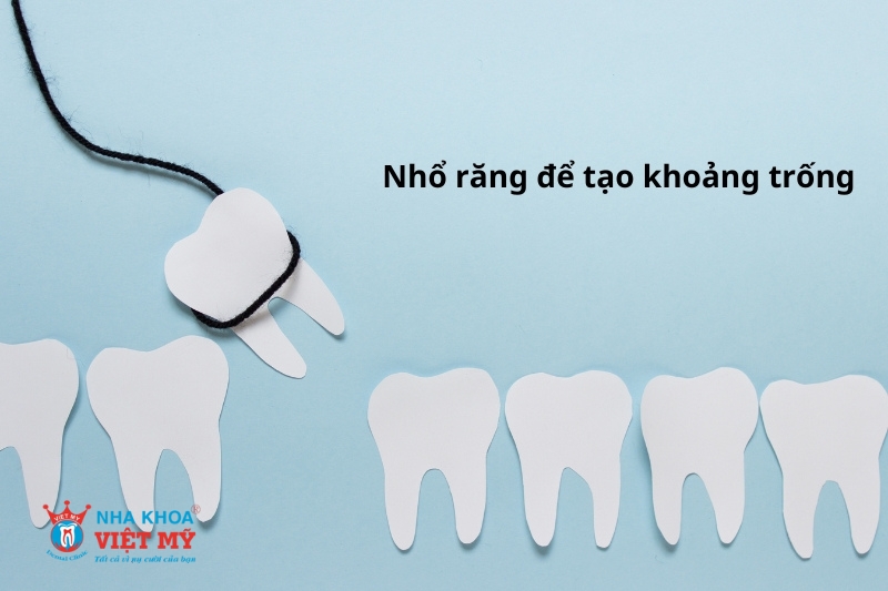 nhổ răng tạo khoảng trống để niềng răng