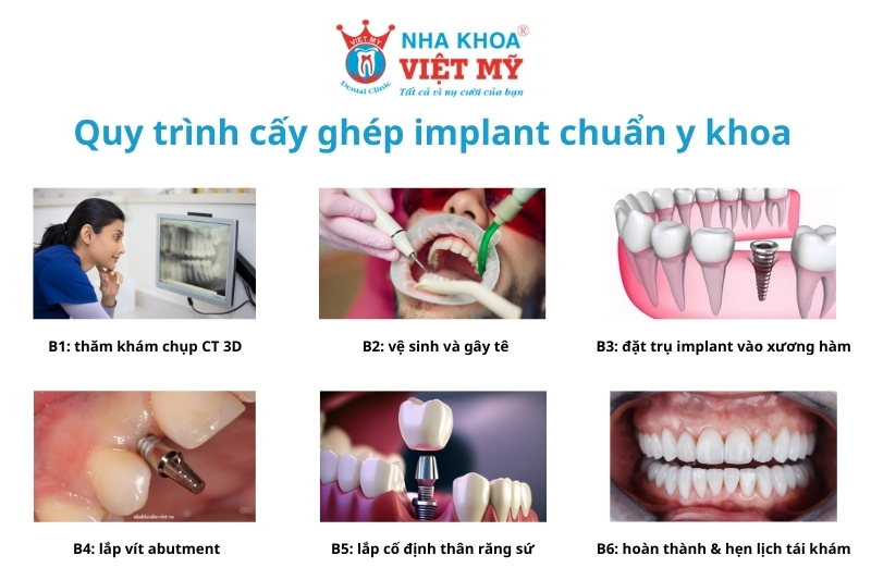 quy trình cấy ghép trồng răng implant chuẩn y khoa