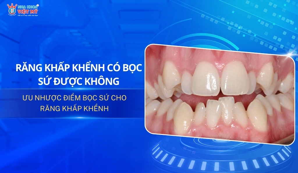 thumbnail răng khấp khểnh có bọc sứ được không