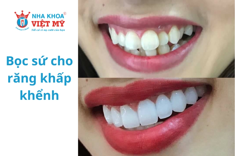 Bọc sứ cho răng khấp khểnh