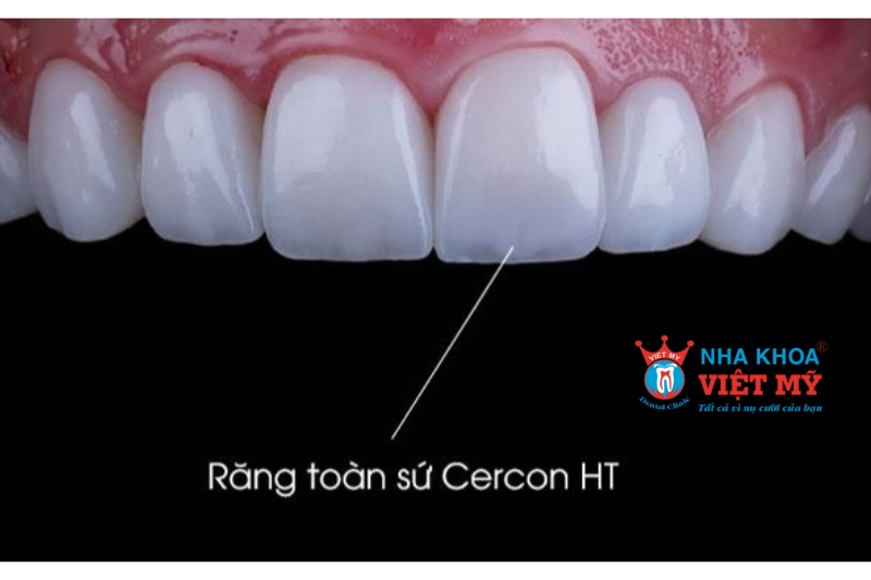 Ưu điểm trắng sáng tự nhiên của răng sứ Cercon