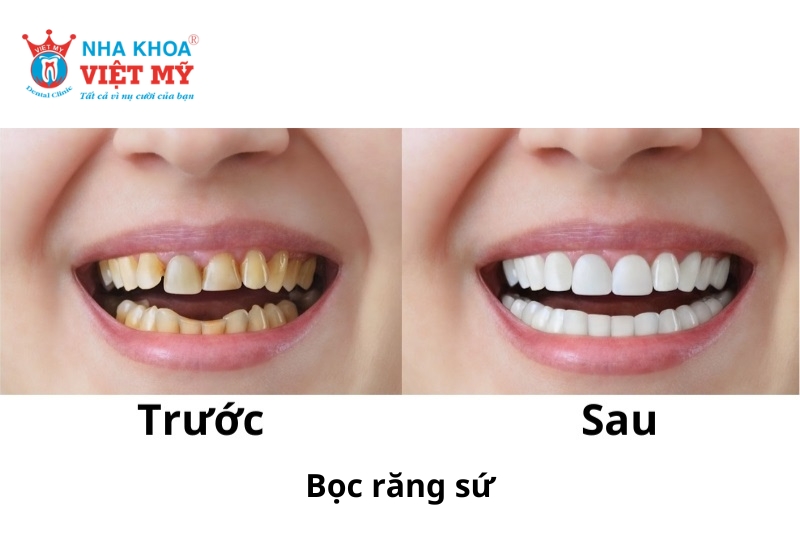 Thời gian giữ độ bền của răng sứ