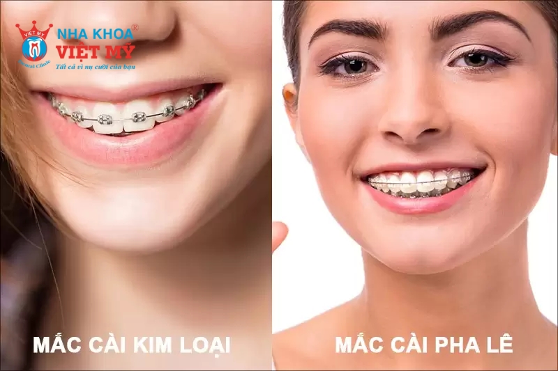 So sánh niềng răng mắc cài kim loại và mắc cài pha lê