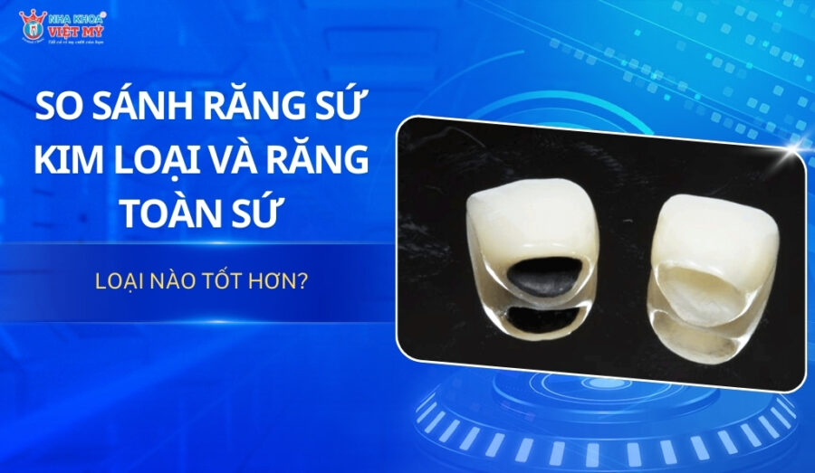 thumbnail so sánh răng sứ kim loại và toàn sứ