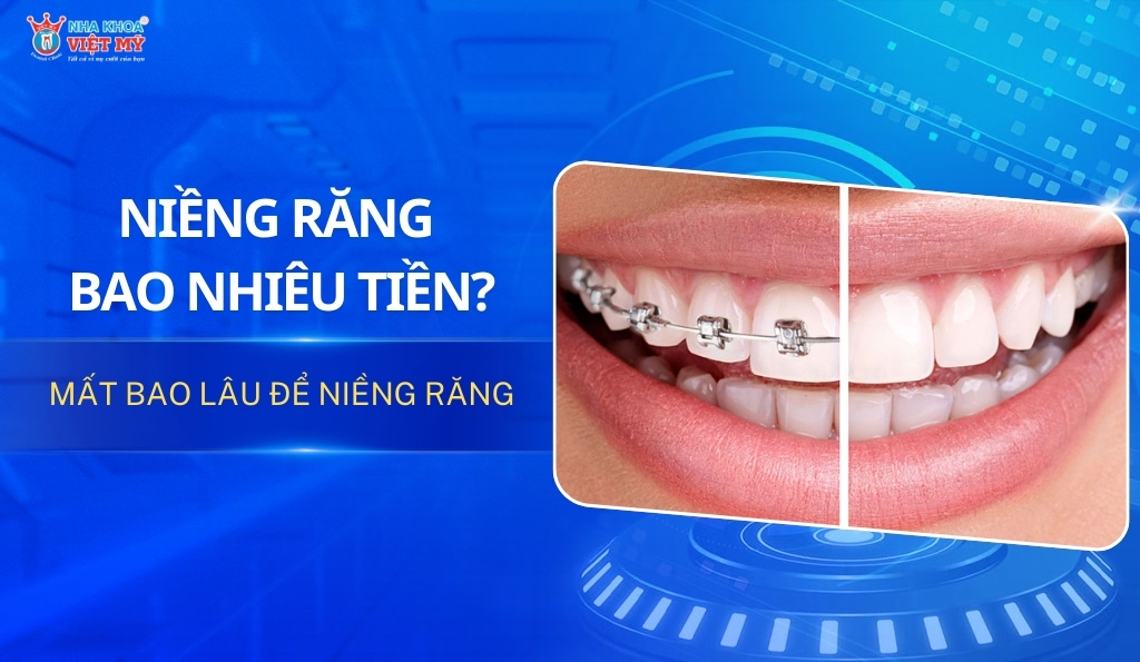 niềng răng giá bao nhiêu tiền thumbnail