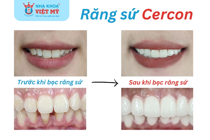 tìm hiểu về răng sứ cercon