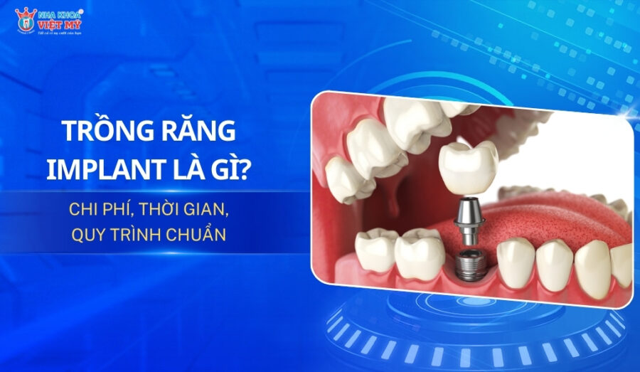 thumbnail trồng răng implant chi phí thời gian quy trình chuẩn