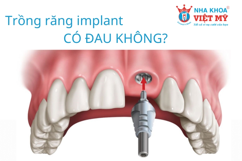 trồng răng implant có đau không kéo dài lâu th?nào