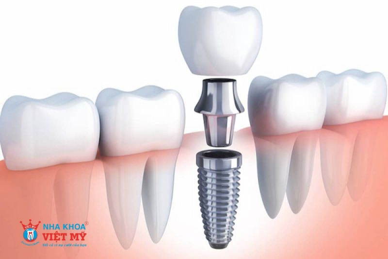 trồng răng implant có vĩnh viển không