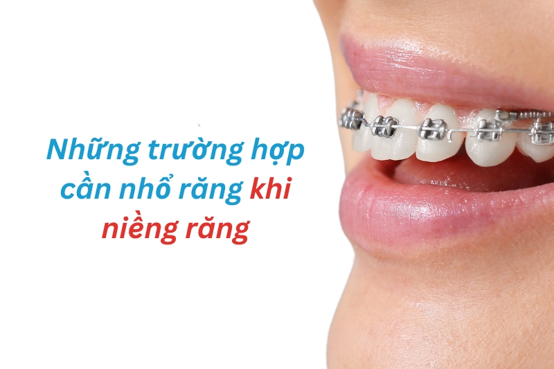 những trường hợp không cần phải nhổ khi niềng răng