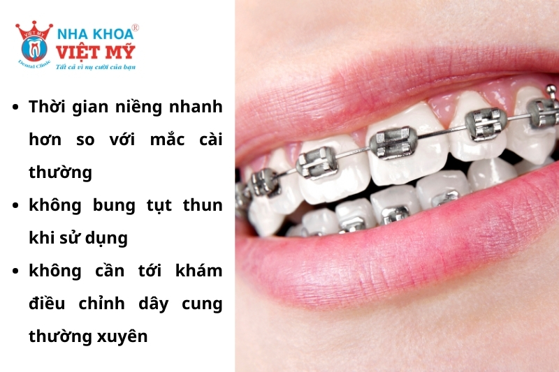 ưu điểm của niềng răng mắc cài kim loại tự buộc