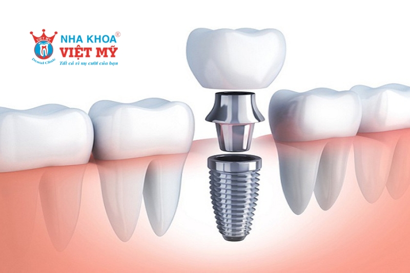 cân nhắc phương pháp trồng răng implant