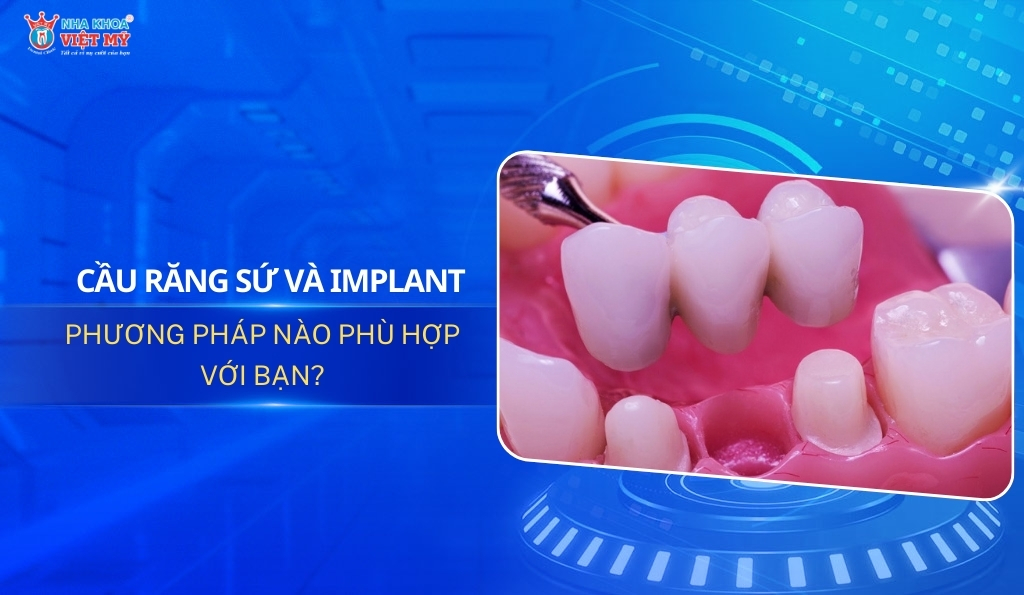 thumbnail cầu răng sứ và implant