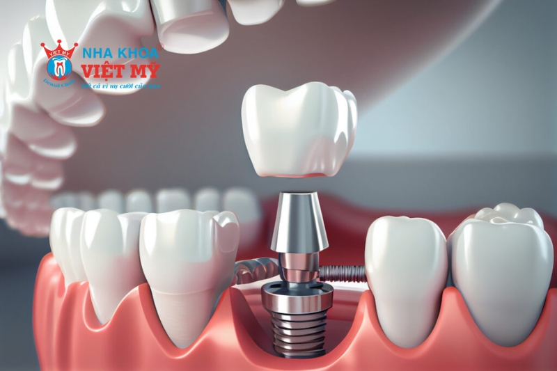 Hạn chế tiêu xương hàm khi cấy ghép implant