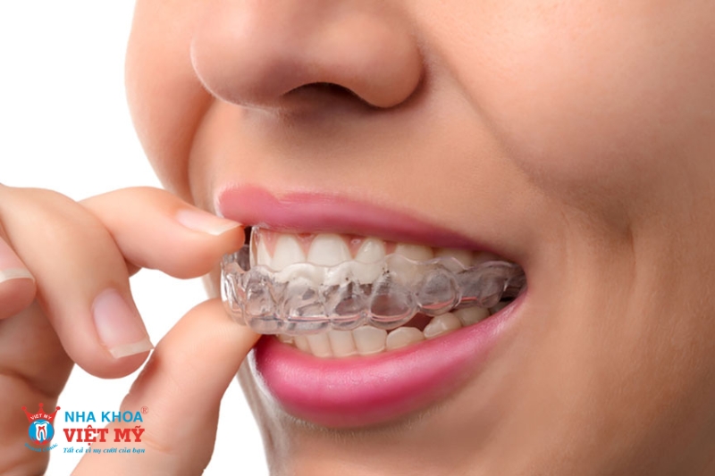 Giá niềng răng trong suốt Invisalign