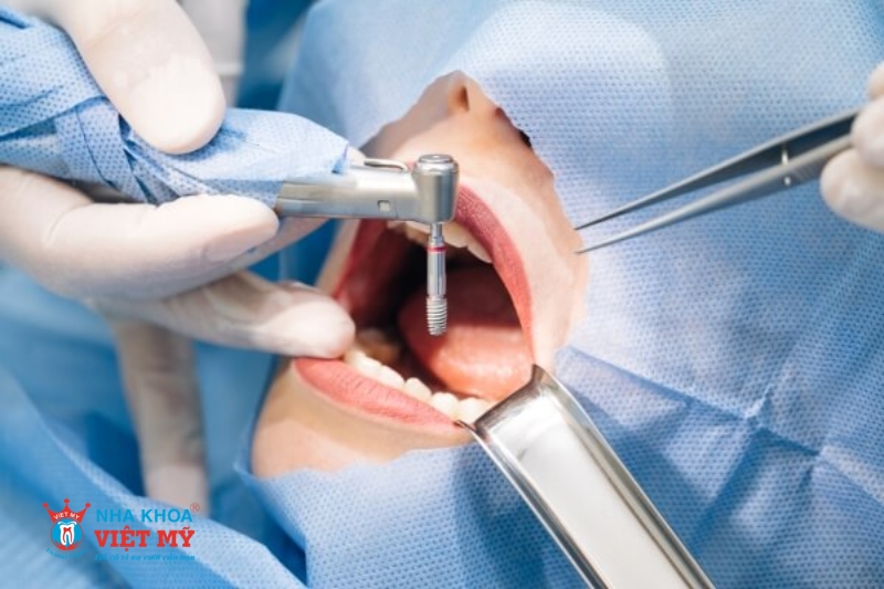 trình đ?chuyên môn của bác sĩ ảnh hưởng đến thời gian trồng răng implant